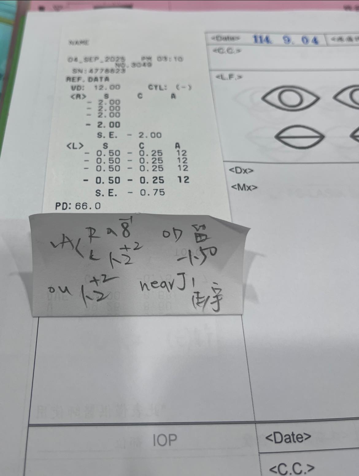 老花近視雷射分享