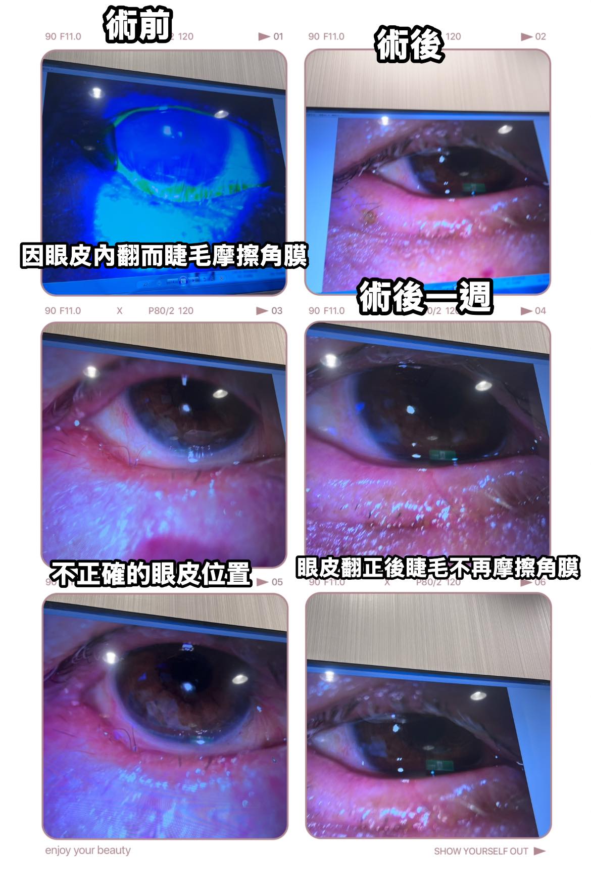 隨著年紀增長 眼皮結構跟力學會改變