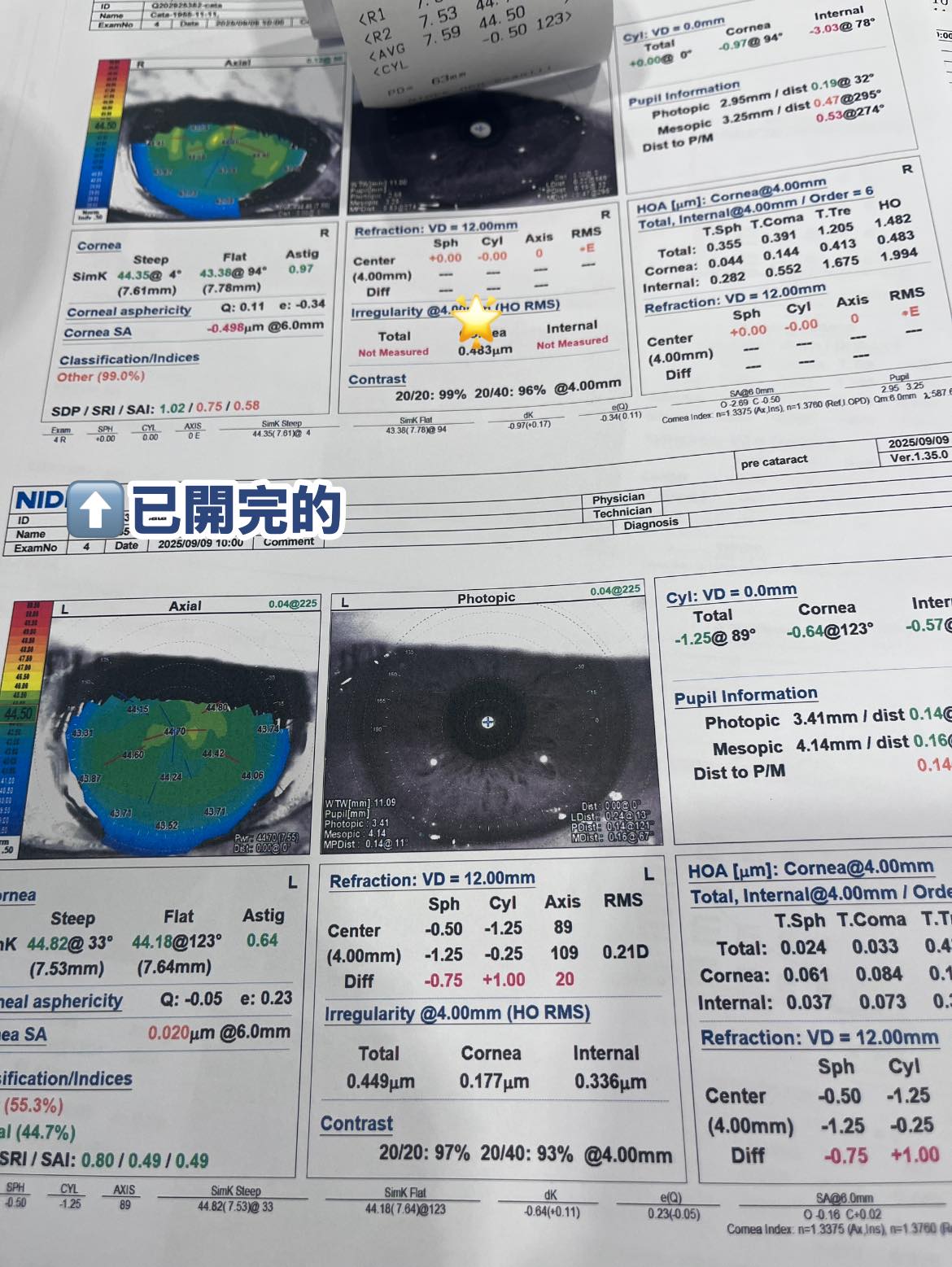 熟透的白內障