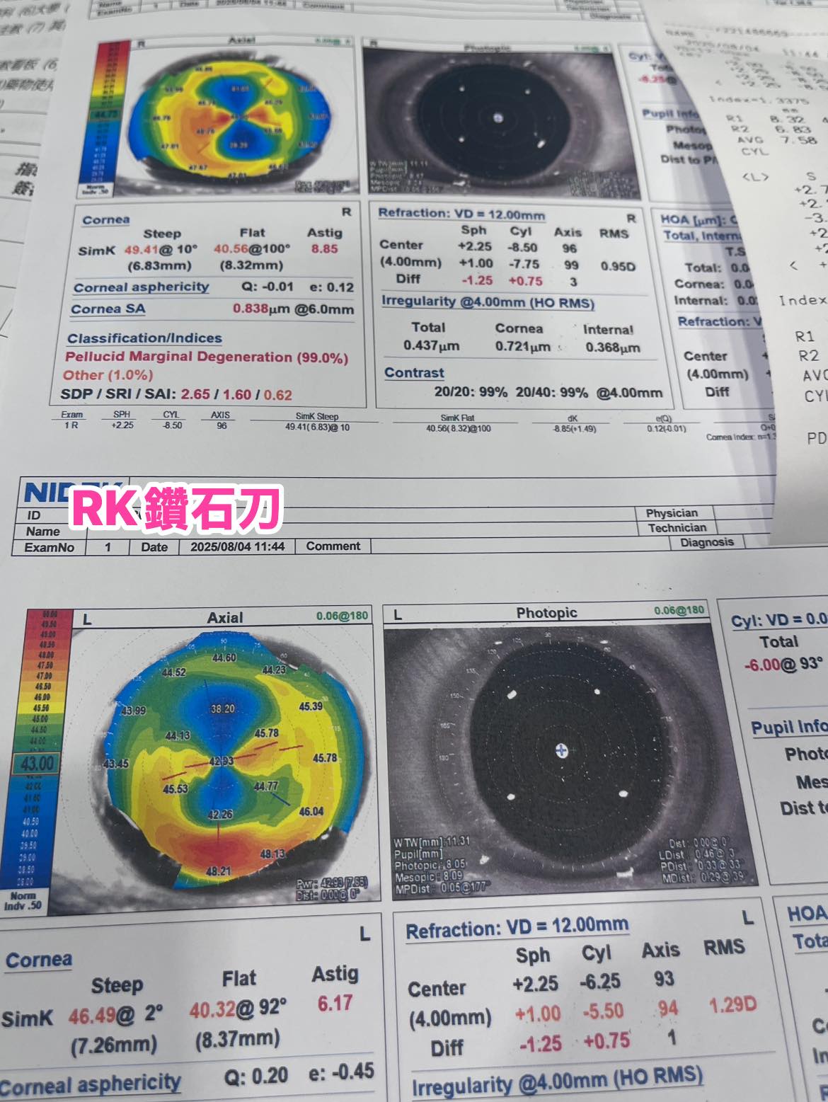 RK的白內障—是一次機會矯正視力嗎？
