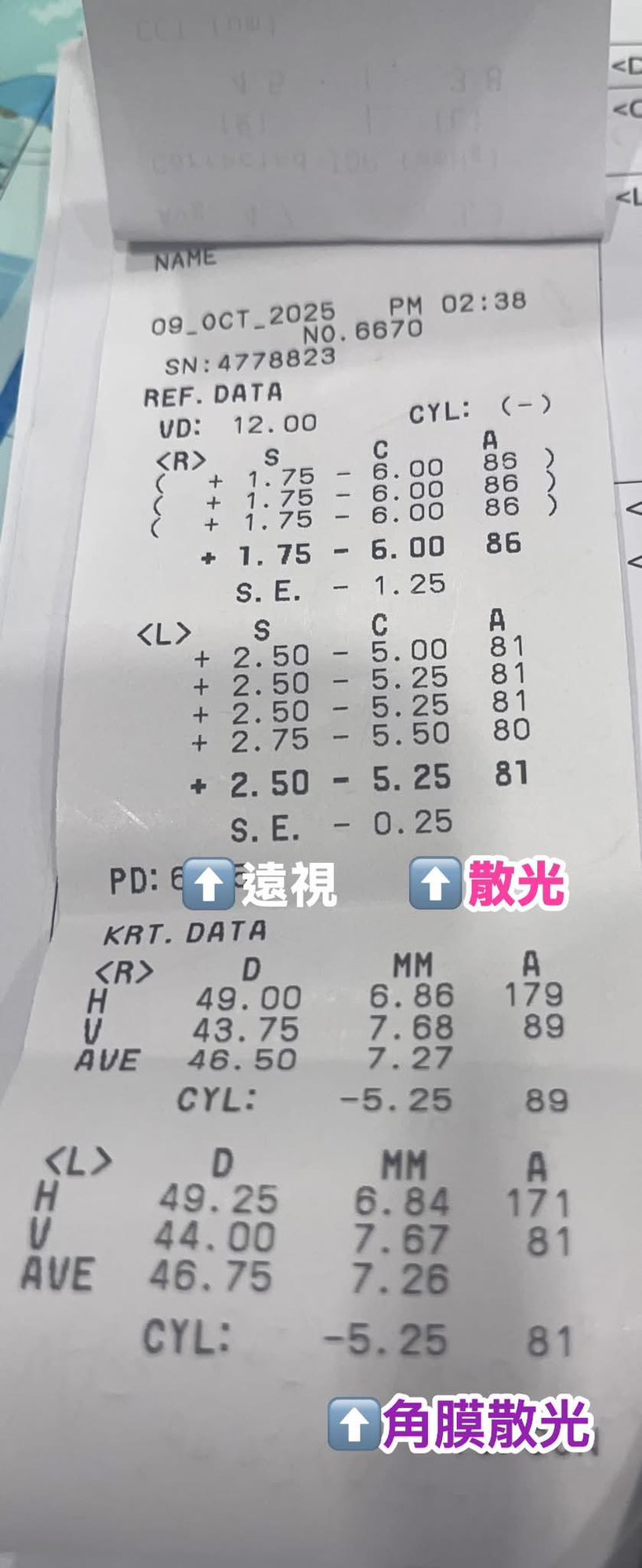 台南近視雷射與白內障案例分享｜高散光患者的真實手術結果與視力表現