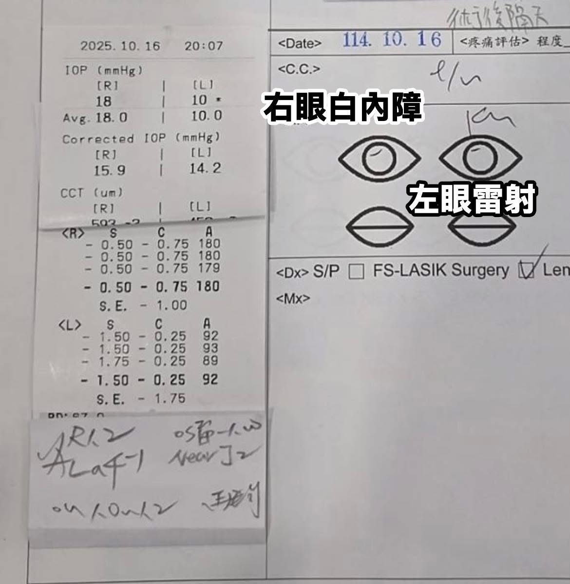 台南近視雷射｜單眼白內障術後視差案例分享