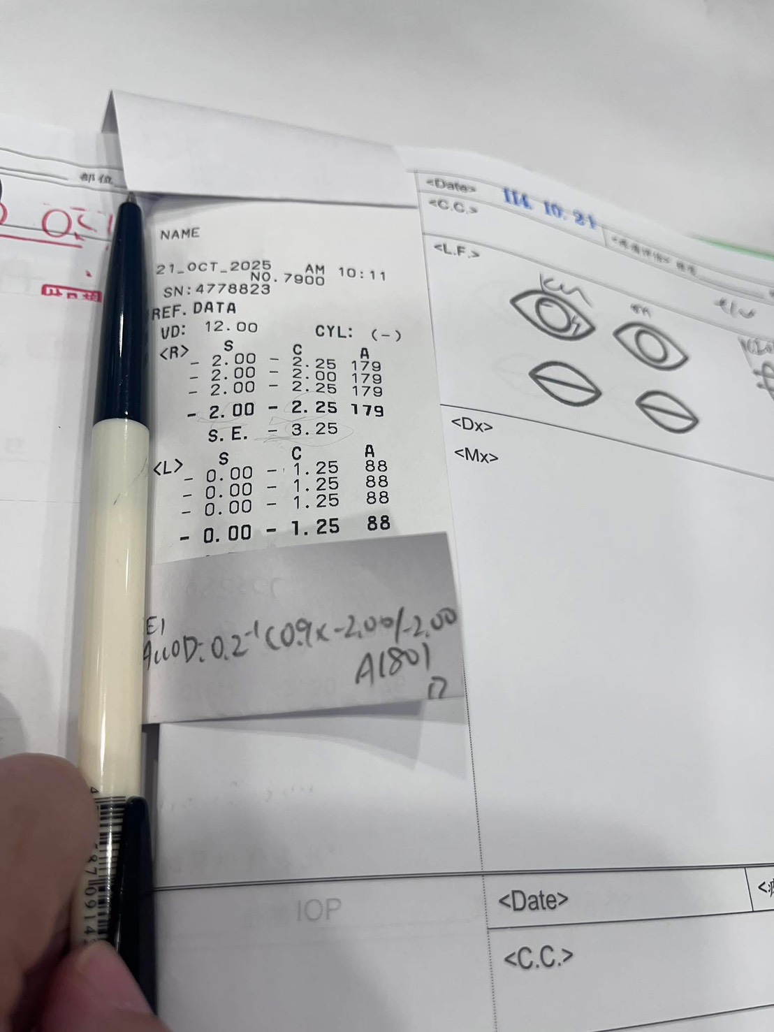 超高度近視白內障（右眼）｜術後一週回診分享｜台南近視雷射